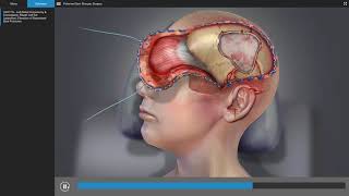 Traumatic Brain Injury  Brain Surgery Animation [upl. by Prima388]