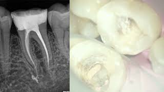 Mandibular Molar Obturation with Bio ceramic Sealer [upl. by Lorine]