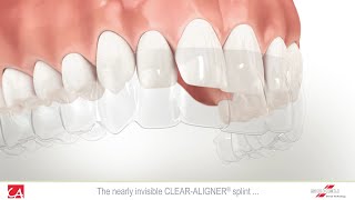 Treatment of Malocclusion Teeth with Invisible Splint [upl. by Standush]