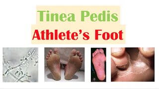 Athlete’s Foot Tinea Pedis Causes Risk Factors Signs amp Symptoms Diagnosis and Treatment [upl. by Ardyth]