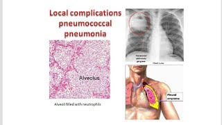 Complications of Pneumonia Adverse Effects [upl. by Sirkin864]