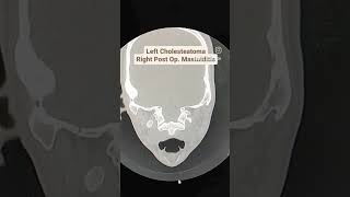 Cholesteatoma with Mastoiditis CT Temporal Bones [upl. by Enaywd544]