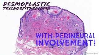 Desmoplastic Trichoepithelioma with perineural involvement [upl. by Malo92]