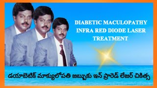 DIABETIC MACULOPATHY INFRA RED DIODE LASER TREATMENT  DrBSUBBARAO [upl. by Acinahs798]