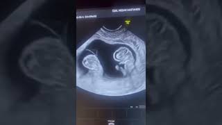 Ultrasound scan In Twins [upl. by Annodas]