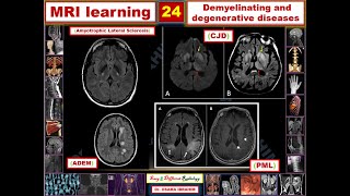 MRI learning 24 Demyelination and degenerative diseases [upl. by Tuttle]