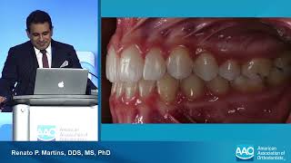 Vertical Control Aligners vs Brackets  Annual Session of the AAO 2024 [upl. by Xylina198]