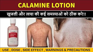 calamine lotion uses  खुजली के लिए बेस्ट लोशन  itching  scabies etc [upl. by Eerrehs]