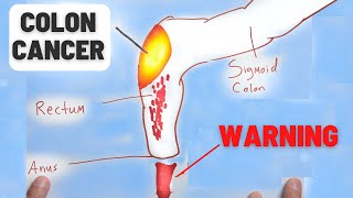 4 Warning Signs of Colon Cancer You Should NEVER Ignore [upl. by Firestone]