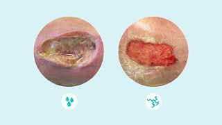 How to assess wound exudate [upl. by Urania675]