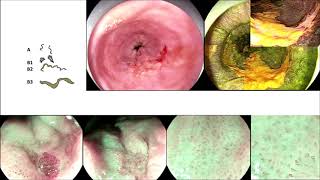 ESD for esophageal Squamous Carcinoma in a Patient with Achalasia [upl. by Haeel]