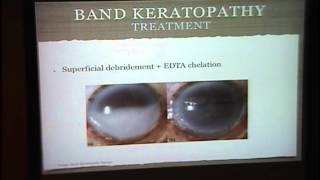 Band Keratopathy Interstitial Keratitis [upl. by Carothers]