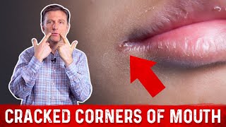 What Causes Cracked Corners of Mouth amp How to Get Rid of Angular Cheilitis – Dr Berg [upl. by Helbona]