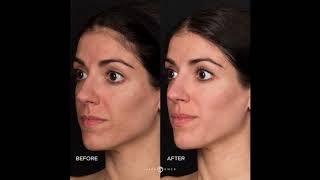 DERMATOLOGIST Acne Scar Treatment  RevePeel TCA PHENOL Before AND After RESULTS  DR JASON EMER [upl. by Samuelson]