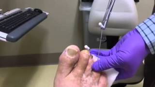 Hammertoe Pin Removal [upl. by Ahtenak]