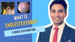 What is Cholesteatoma  an ear surgeon explains [upl. by Akenna418]