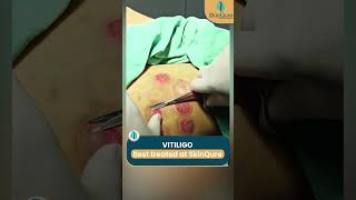 Vitiligo Treatment at SkinQure  Permanent cure for vitiligo [upl. by Yennep425]