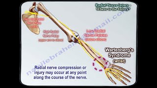 Radial Nerve InjuryWhere Is The Injury  Everything You Need To Know  Dr Nabil Ebraheim [upl. by Leirua698]