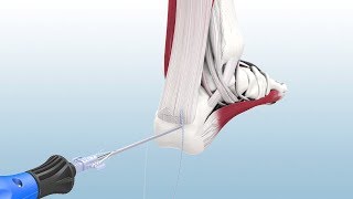 Haglunds Excision and Achilles Reconstruction Using the CuffLink™ System  CONMED Animation [upl. by Eshman]