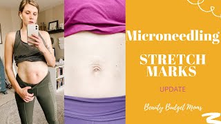 STRETCH MARKS MICRONEEDLING PROCEDURE  MDPEN TRAINING [upl. by Nanny801]