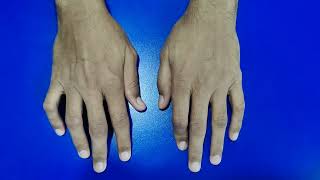 Flexion and Boutonniere Deformities in Rheumatoid Arthritis [upl. by Bahr]