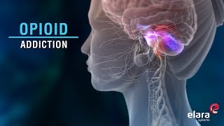 What is Opioid Addiction Animation Video Answers the Question [upl. by Ailuj714]