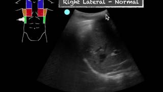 POCUS  Teaching Point  Ultrasound vs CXR in pneumonia [upl. by Yerak]