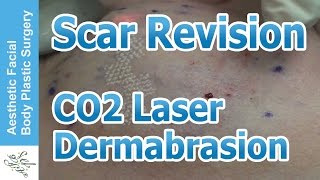 Laser Scar Revision With CO2 Laser Part 02 by Dr Philip Young Bellevue Seattle Washington [upl. by Karb842]