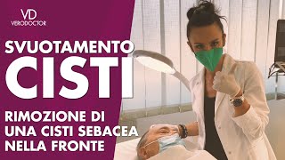 Svuotamento di una cisti sebacea nella fronte  veloce in ambulatorio  VERODOCTOR [upl. by Lennej]