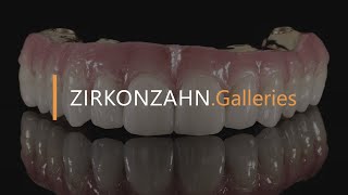 Prettau® 4 Anterior® zirconia on Sintermetall  ZirkonzahnGalleries [upl. by Ardnuassak636]