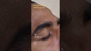 Pterygo  Pterygium surgery using Scleral BCL Pterygo Pterygium Autograft Noglue NoSuture [upl. by Oiruam]