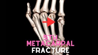 5th Metacarpal bone fracture [upl. by Nrubyar]