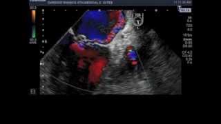 mitral valve prolapse of posterior leaflet middle scallop P2 [upl. by Epoh742]