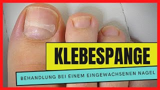 EINGEWACHSENEN NAGEL mit einer KLEBESPANGE behandeln  Podostripe Klebespange [upl. by Oile]