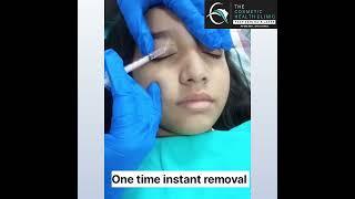 Keratin cysts removal treatmentNow easily get rid of it Book your appointment now [upl. by Ihtraa552]