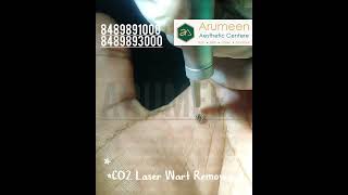 Get Rid Of the WartsLaser Wart RemovalPainless Wart Removalwart laser skincare trichy tamil [upl. by Quita]