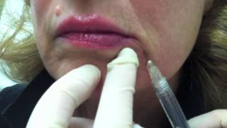 Juvederm for Smile Lines [upl. by Behlke]