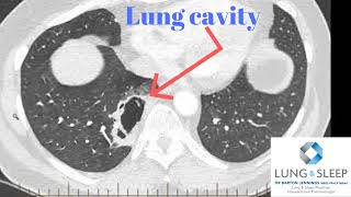 Cavitating lesion in the right lower lobe of the lung [upl. by Pavlov]