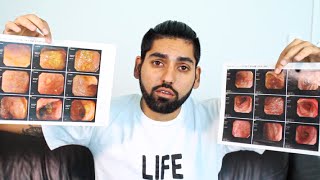 Proof that Ulcerative Colitis can be HEALED CURED amp REVERSED  Heal Ulcerative Colitis [upl. by Aryek]