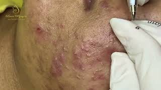 Loan Nguyen Acne Treatment 17744 [upl. by Nonnairb]