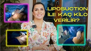 Liposuction ile Kaç Kilo Verilir [upl. by Nylazor500]