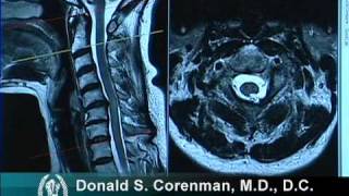 How to Read a MRI of Cervical Stenosis with Spinal Cord Injury  Spine Surgeon in Colorado [upl. by Dedrick]