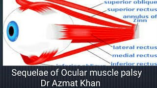 Sequelae of Ocular Muscle palsy  Hering and Sherington laws  Yoke muscle [upl. by Alemahs246]