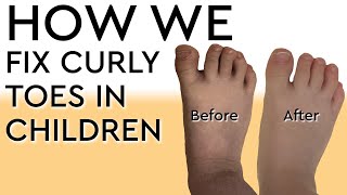 How We Fix Curly Toes in Children [upl. by Olnee586]