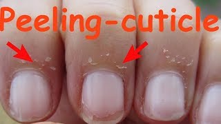 How to care for Skin Peeling near Nails  DIY 4 30days30diy [upl. by Duer]