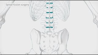 How back surgery spinal fusion is performed  Spire Healthcare [upl. by Ostler]