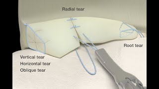 AllInside Meniscus Repair Procedures with Double Medical MLink System  StepbyStep Animation [upl. by Germin834]