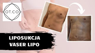 Liposukcja Vaser Lipo najważniejsze aspekty zabiegu  OTCO Clinic [upl. by Ardnuahc154]