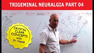 Trigeminal Neuralgia  Causes and Treatment  Part 4 [upl. by Polly800]