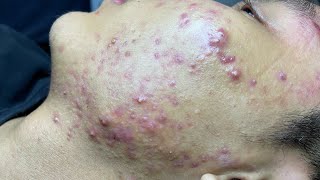 ACNE TREATMENT VU QUYNH MI Blackheads On Boy Face 2024 [upl. by Fesuy]